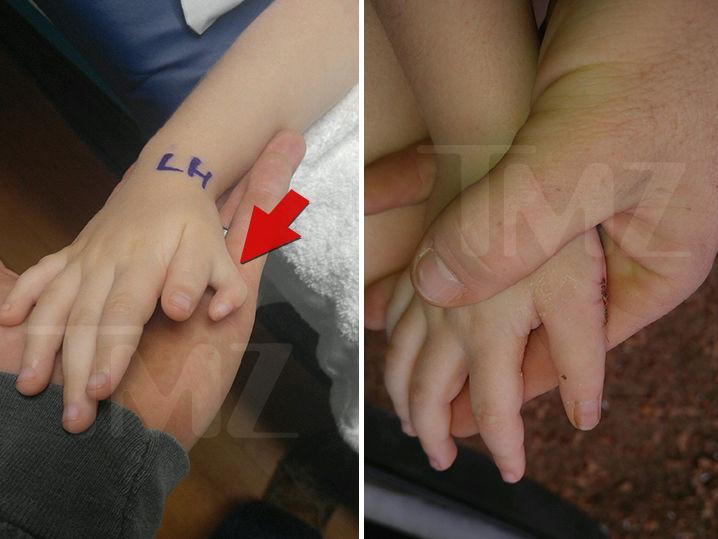 'Honey Boo Boo' Star -- My Extra Thumb Went Poof, Here's the Proof! (Photos)