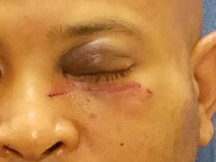 Mike Epps' Alleged Battery Victim Has Gnarly Black Eye (Photo Gallery + Video)