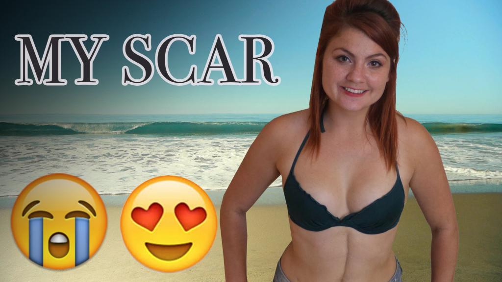 MY HUGE SCAR : Learning To Live With It & Body Confidence - YouTube