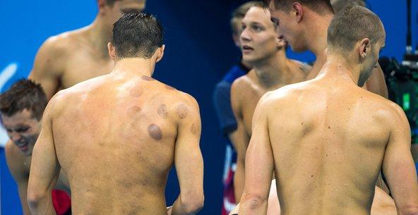 What Are The Purple Dots On Michael Phelps? Cupping Has An Olympic